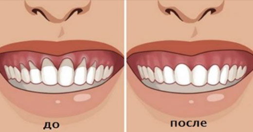 Вы заметили оголение шейки или корня зуба? Немедленно начинайте лечение — 6 натуральных рецептов!