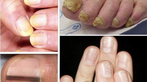 7 общих состояний ногтей, которые указывают на серьезные заболевания. Не игнорируйте их!