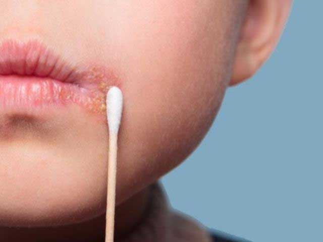 Почему появляется герпес на губах. Лечение герпеса в домашних условиях